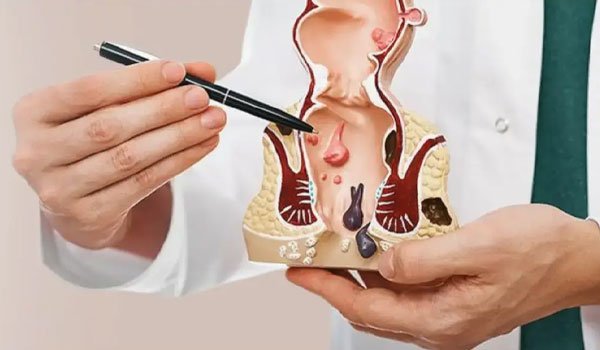 Fistula