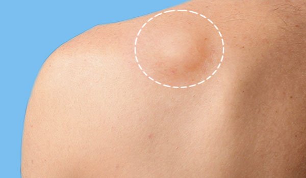 Lipoma